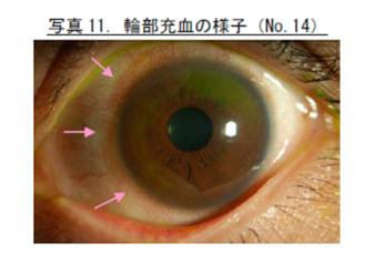 輪部充血の様子