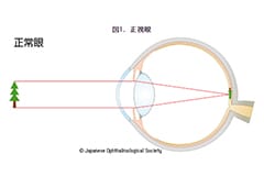 屈折異常について