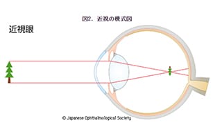 近視